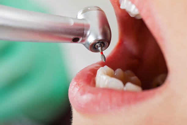 Best Emergency Cosmetic Dentistry (e.g., broken veneers) in Douglasville, GA